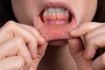Signs Of Damage to Dental Pulp