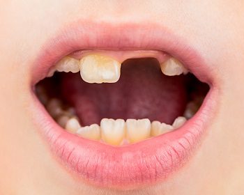 Cavities in Kids