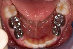 Tooth Restoration Solution