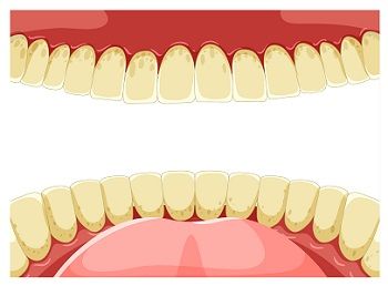 Teeth discoloration