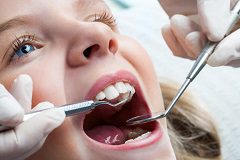 Cracked and Chipped Teeth