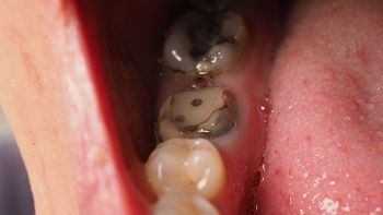 Damaged Dental Pulp