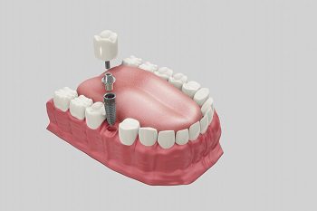 Dental Implants