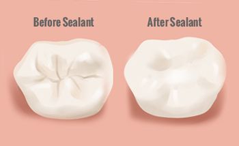 Before and After Dental Sealant