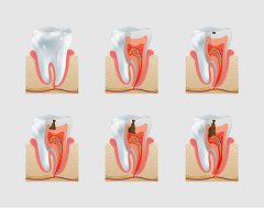 Fluoride is Helpful 