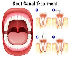 Root Canal May Be Needed as a Way to Deal with Infection