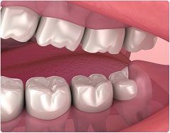 Understanding Wisdom Tooth Removal