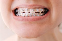 Best Ways to Keep Kids' Teeth Aligned