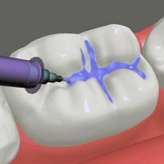 All About Dental Sealants for Kids