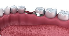 Dental Space Maintainers