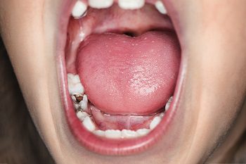 Tooth Decay